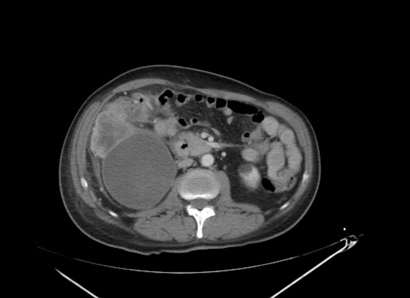File:Colon cancer mimicking renal cell carcinoma (Radiopaedia 28986-29335 C 36).jpg