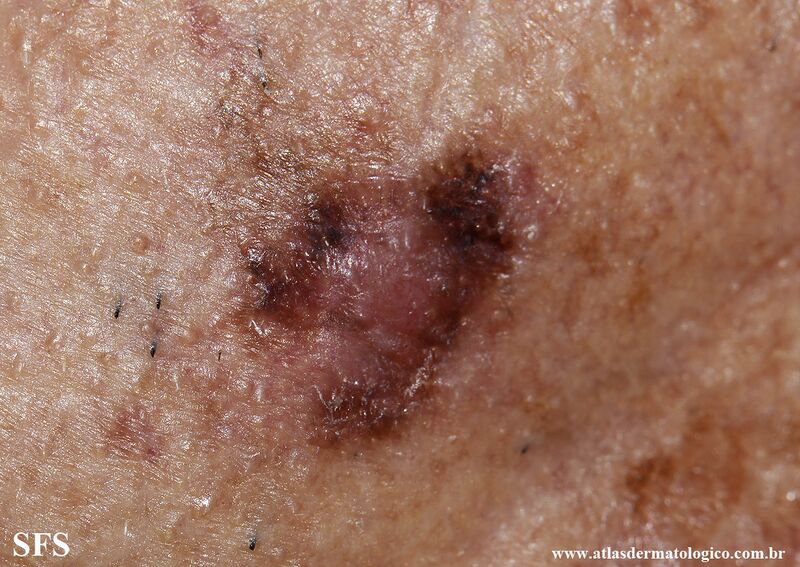 File:Melanoma (Dermatology Atlas 126).jpg