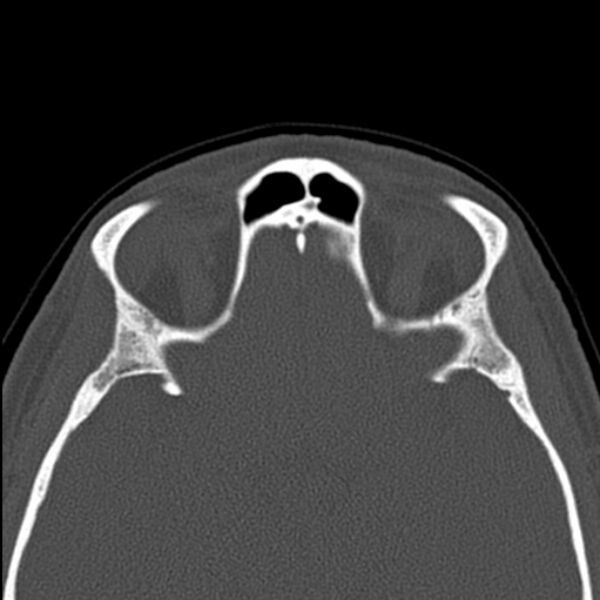 File:Nasal septal perforation (Radiopaedia 25030-25289 Axial bone window 55).jpg