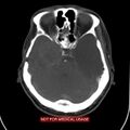 Nasopharyngeal carcinoma recurrence - skull base destruction (Radiopaedia 29107-29491 A 2).jpg
