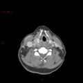 Nasopharyngeal lymphoma (Radiopaedia 54235-60433 A 10).jpg