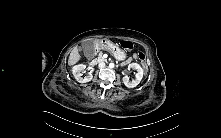 Neo-terminal ileal stricture (Crohn disease) (Radiopaedia 33790-34948 A 172).jpg