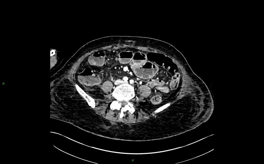 Neo-terminal ileal stricture (Crohn disease) (Radiopaedia 33790-34948 A 276).jpg