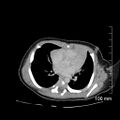 Neonatal neuroblastoma (Radiopaedia 56651-63438 Axial non-contrast 1).jpg