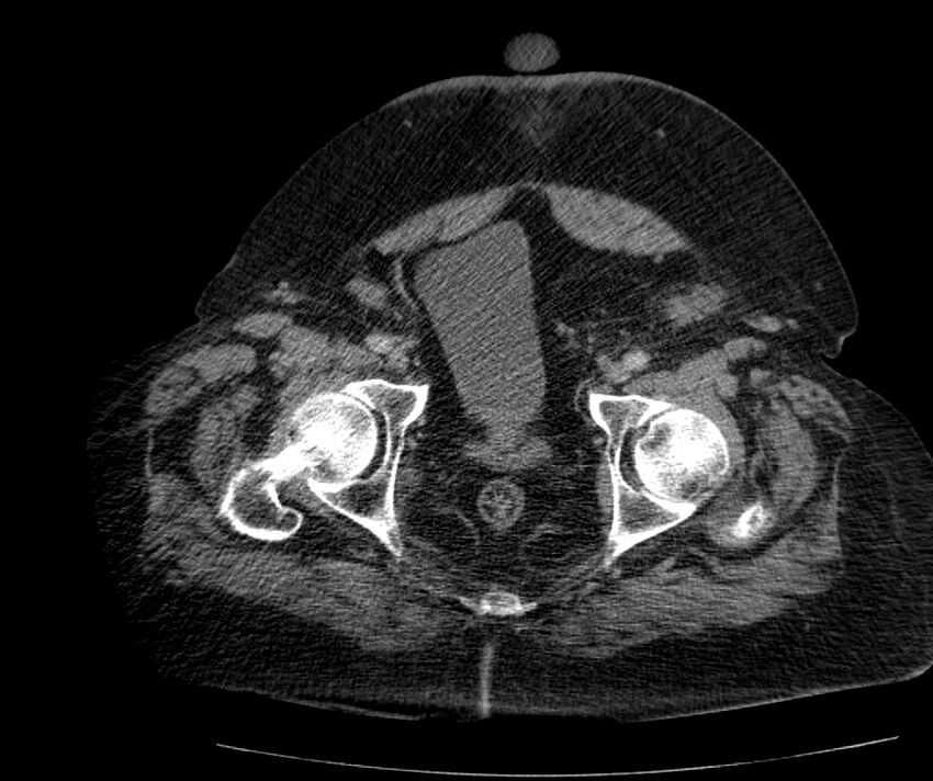 Nephroptosis with inguinal hernia containing perirenal fat (Radiopaedia 56632-63391 C 311).jpg