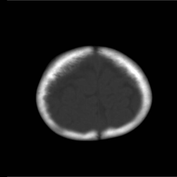 File:Neuroblastoma with skull metastases (Radiopaedia 30326-30958 Axial bone window 21).jpg