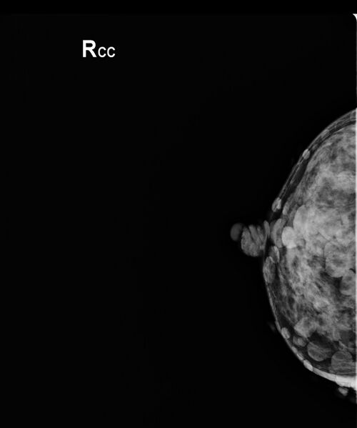 File:Neurofibromatosis of the breast (Radiopaedia 49024-54114 C 1).jpeg