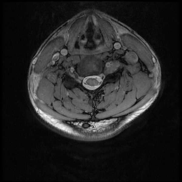 File:Neurofibromatosis type 2 (Radiopaedia 44936-48837 Axial Gradient Echo 18).png