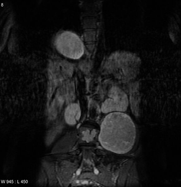 File:Neurofibromatosis type 2 - cranial and spinal involvement (Radiopaedia 5351-7112 D 2).jpg