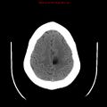 Neuroglial cyst (Radiopaedia 10713-11185 Axial non-contrast 7).jpg