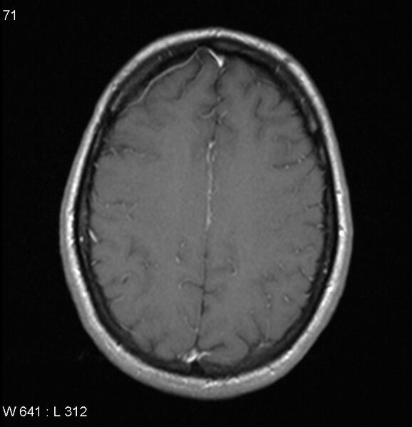 File:Neurosarcoidosis (Radiopaedia 10930-17204 Axial T1 C+ 14).jpg
