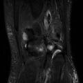 Non-displaced patella fracture (Radiopaedia 15932-15582 Coronal STIR 19).jpg