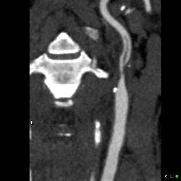 File:Non-occlusive intraluminal internal carotid artery thrombus (Radiopaedia 37751-39658 A 37).jpg