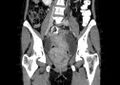 Non-puerperal uterine inversion (Radiopaedia 78343-91094 B 5).jpg