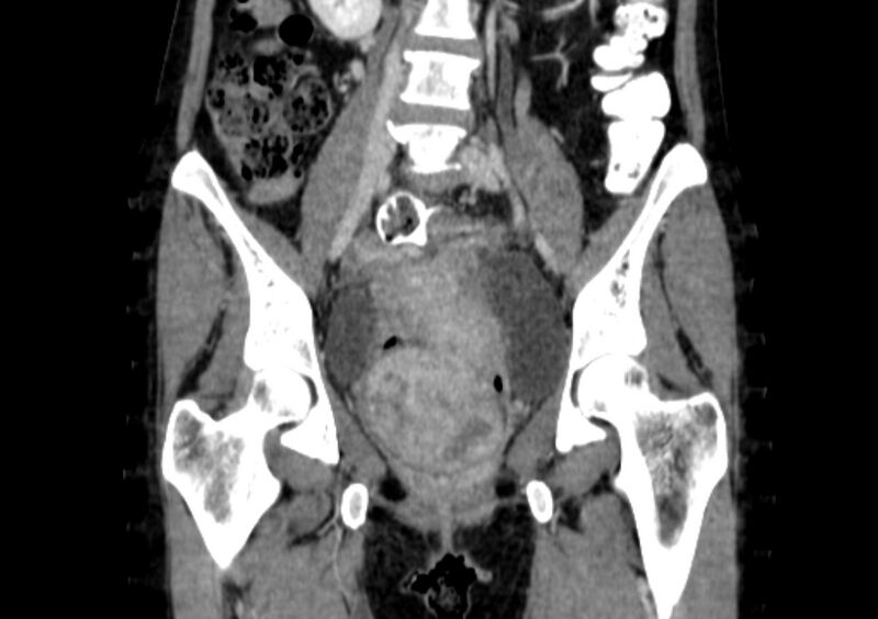 File:Non-puerperal uterine inversion (Radiopaedia 78343-91094 B 5).jpg