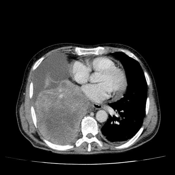 File:Non small-cell lung cancer (Radiopaedia 24467-24769 C+ delayed 39).jpg