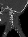 Normal CT cervical spine - pediatric (Radiopaedia 52549-58462 Sagittal bone window 175).jpg