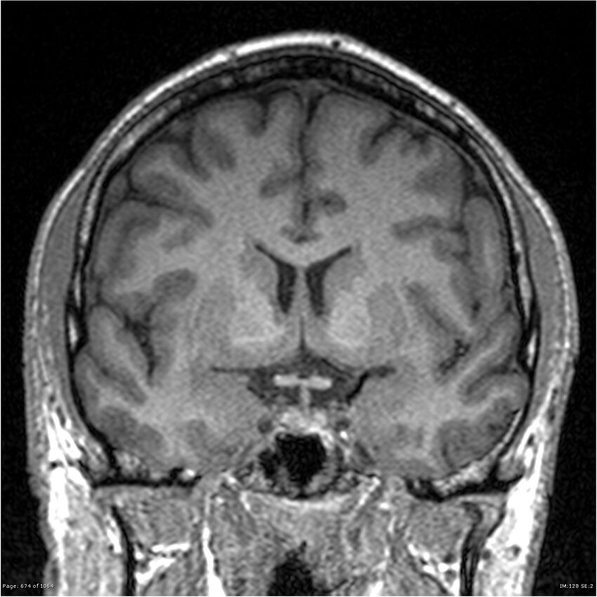 Normal brain MRI (non-focal epilepsy protocol) (Radiopaedia 38571-40700 Coronal T1 63).jpg
