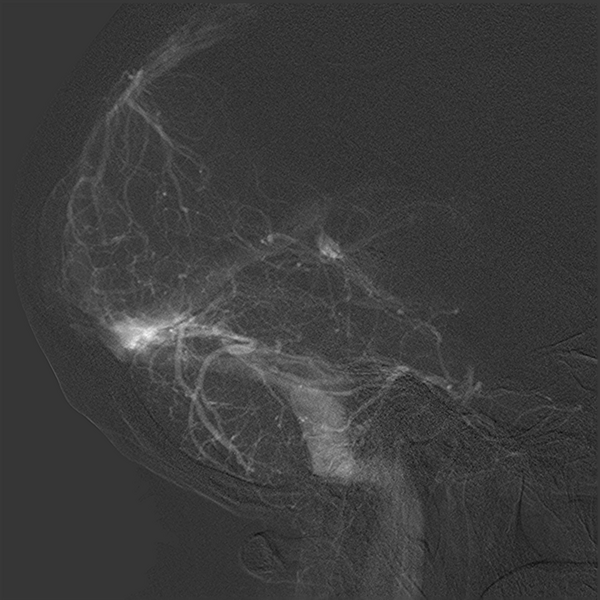 File:Normal cerebral angiogram (four vessel DSA) (Radiopaedia 41708-44649 L 18).png