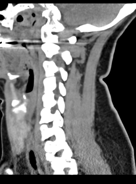 File:Normal cervical spine MRI (including Dixon) (Radiopaedia 42762-45926 C 23).png