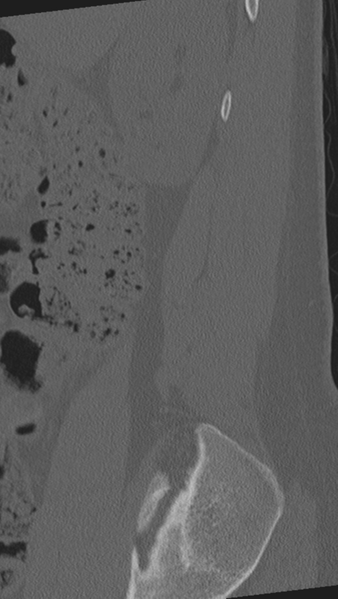 File:Normal lumbar spine CT (Radiopaedia 46533-50986 Sagittal bone window 91).png