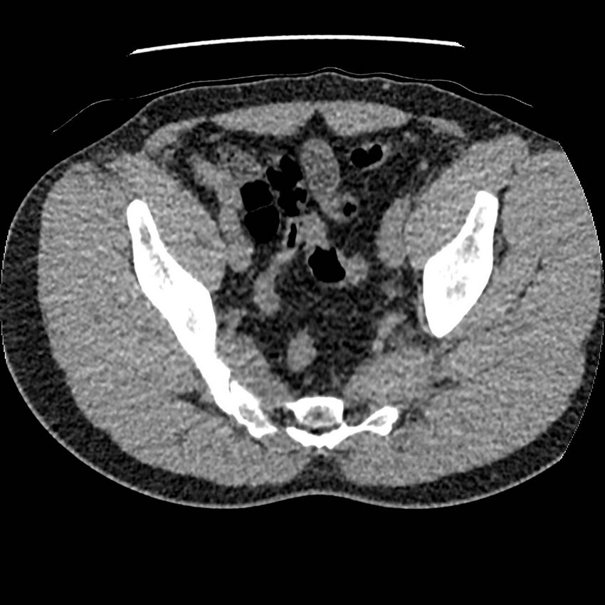 Obstructing ureteric calculus and ureteric anatomy (Radiopaedia 62730-71042 Axial non-contrast 139).jpg