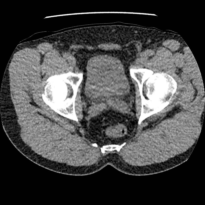 Obstructing ureteric calculus and ureteric anatomy (Radiopaedia 62730-71042 Axial non-contrast 160).jpg