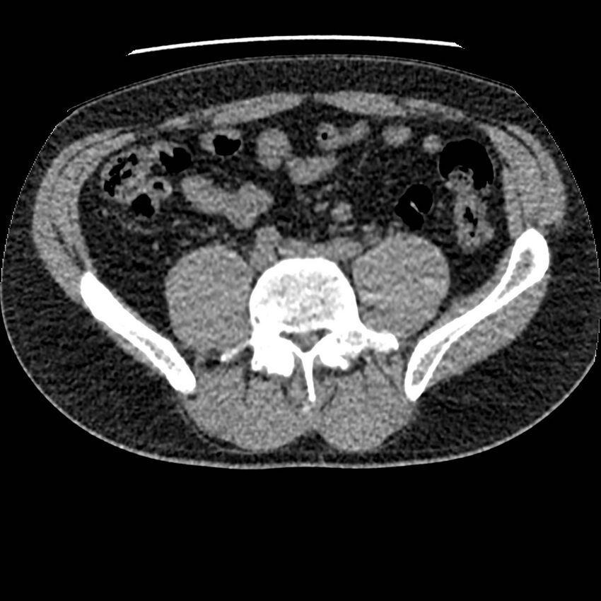Obstructing ureteric calculus and ureteric anatomy (Radiopaedia 62730-71042 Axial non-contrast 97).jpg