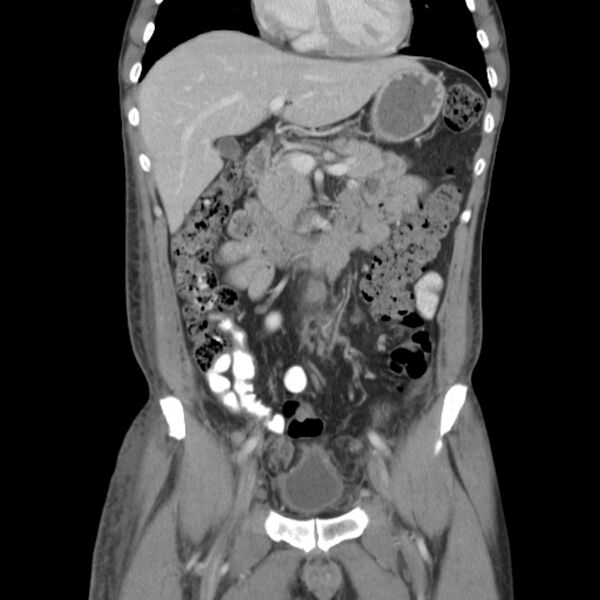 File:Obstructive bladder transitional cell carcinoma (Radiopaedia 9825-10410 B 6).jpg