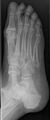 5th metatarsal fracture (Radiopaedia 6378-7738 Oblique 1).jpg