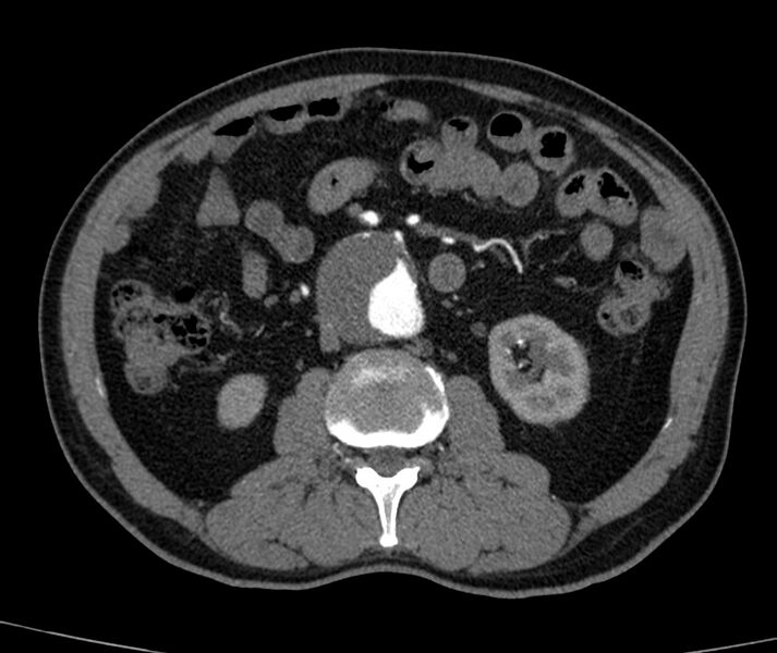 File:Abdominal aortic aneurysm (Radiopaedia 22421-22458 C+ arterial phase 41).jpg