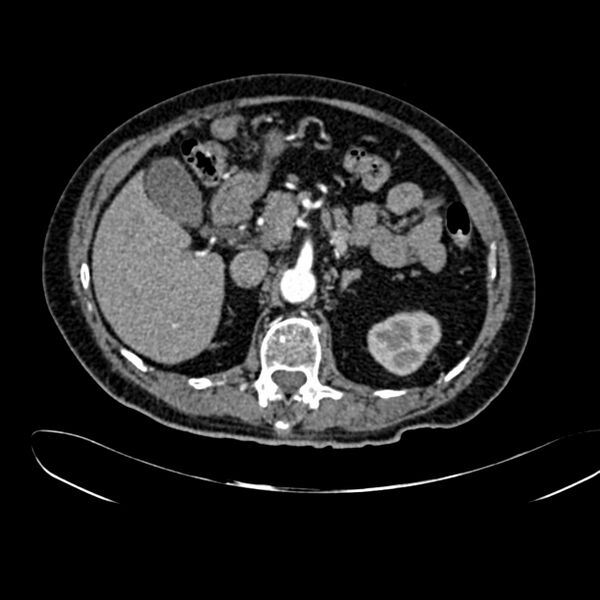 File:Abdominal aortic aneurysm (Radiopaedia 75131-86203 Axial C+ arterial phase 15).jpg