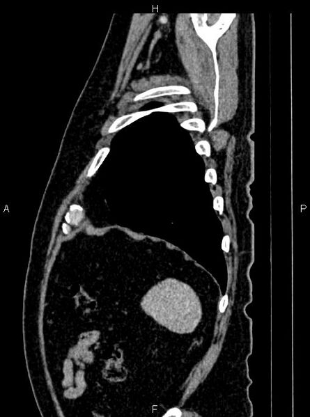File:Abdominal aortic aneurysm (Radiopaedia 83094-97462 Sagittal renal cortical phase 106).jpg