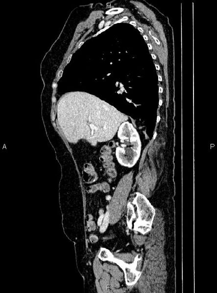 File:Abdominal aortic aneurysm (Radiopaedia 85063-100606 Sagittal C+ arterial phase 24).jpg