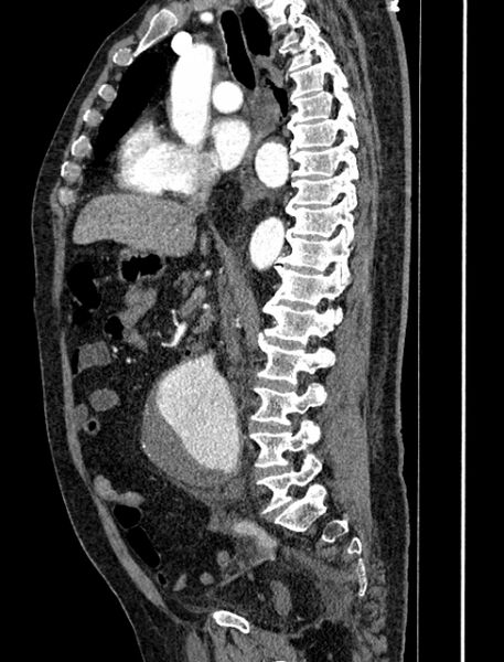 File:Abdominal aortic aneurysm rupture (Radiopaedia 54179-60362 Sagittal C+ arterial phase 19).jpg