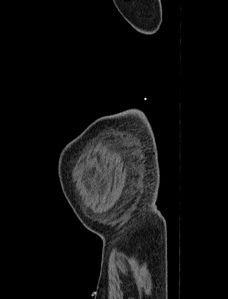File:Abdominal aortic aneurysm rupture (Radiopaedia 54179-60362 Sagittal C+ arterial phase 48).jpg