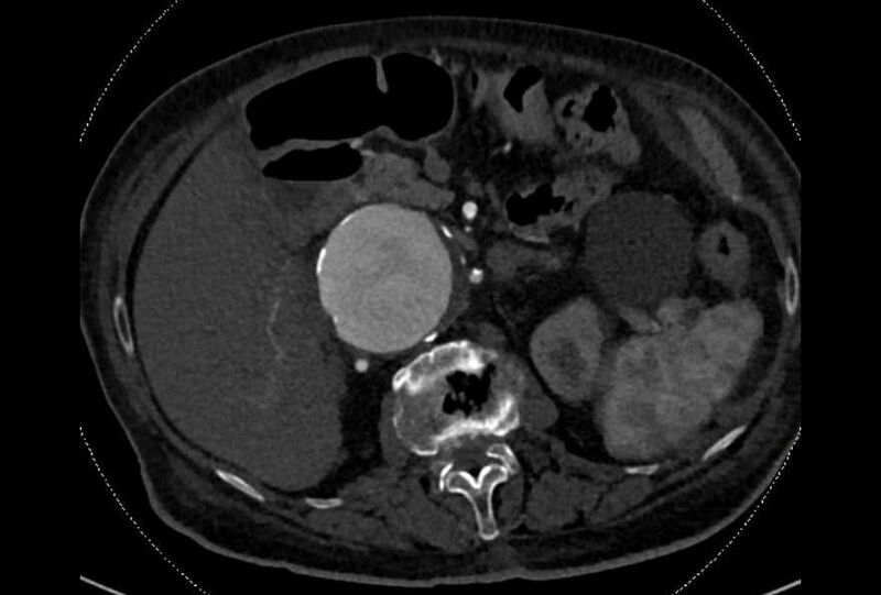 File:Abdominal aortic aneurysm with thrombus fissuration (Radiopaedia 73192-83919 Axial C+ arterial phase 49).jpg