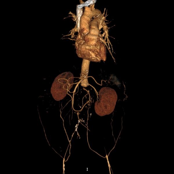 File:Abdominal aortic interposition tube graft and aneurysm thrombosis (Radiopaedia 71438-81857 3D VRT C+ arterial phase 2).jpg