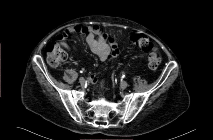 Abdominal aortic interposition tube graft and aneurysm thrombosis (Radiopaedia 71438-81857 Axial C+ arterial phase 166).jpg