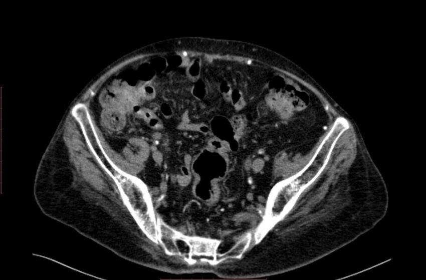 Abdominal aortic interposition tube graft and aneurysm thrombosis (Radiopaedia 71438-81857 Axial C+ arterial phase 179).jpg