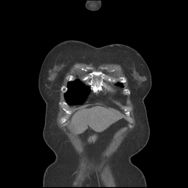 File:Aberrant right subclavian and left vertebral arteries (Radiopaedia 43467-46847 Coronal C+ portal venous phase 8).jpg