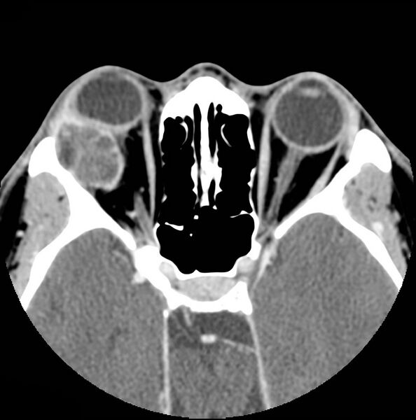 File:Acinic cell carcinoma of the lacrimal gland (Radiopaedia 9480-10160 Axial C+ arterial phase 6).jpg