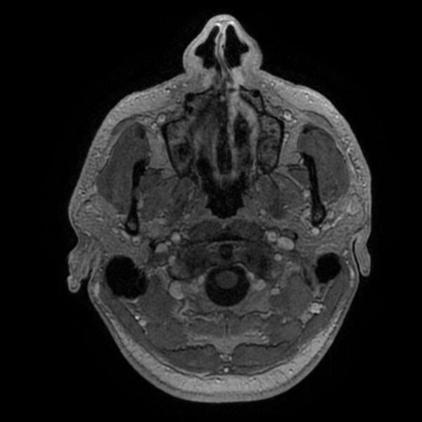 File:Acoustic schwannoma - intracanalicular (Radiopaedia 37247-39024 Axial T1 C+ 19).jpg