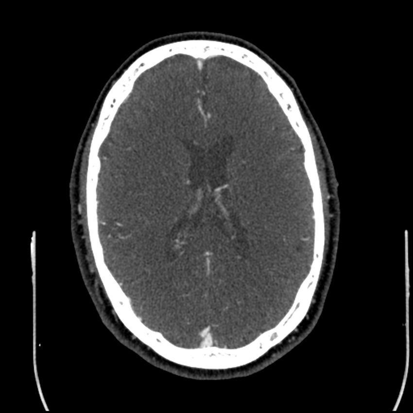 Acute A3 occlusion with ACA ischemic penumbra (CT perfusion) (Radiopaedia 72036-82527 Axial C+ arterial phase thins 43).jpg