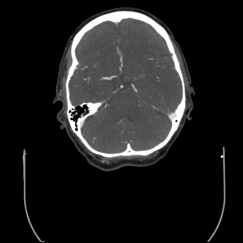 Acute M1 occlusion with ischemic penumbra (CT perfusion) (Radiopaedia 71897-82344 Axial C+ arterial phase thins 89).jpg