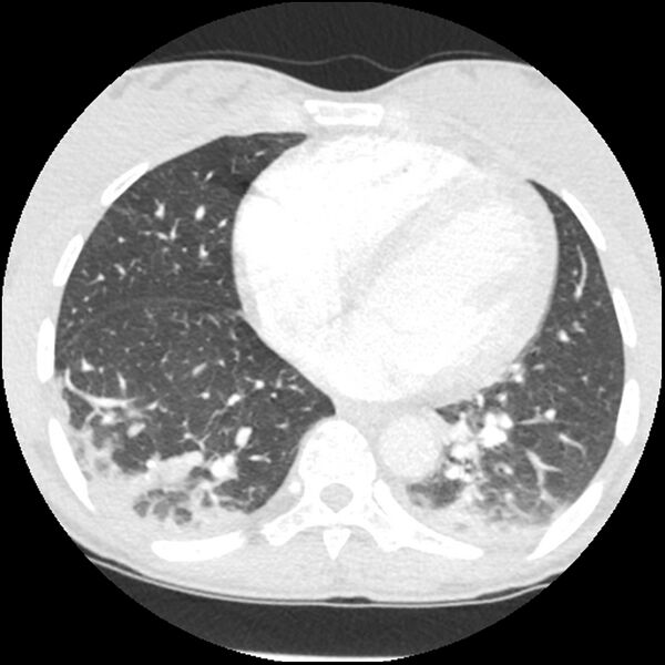 File:Acute chest syndrome - sickle cell disease (Radiopaedia 42375-45499 Axial lung window 129).jpg