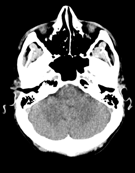 File:Acute disseminated encephalomyelitis (ADEM) (Radiopaedia 65319-74348 Axial non-contrast 8).png