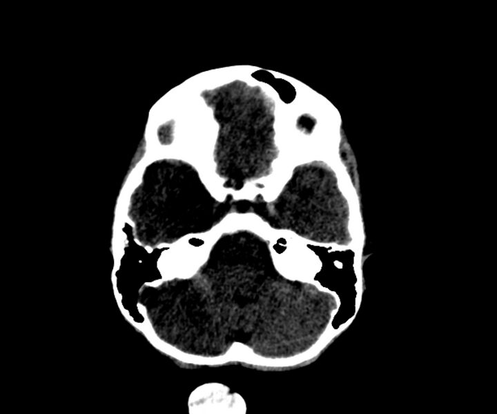 File:Acute epidural hematoma (Radiopaedia 63659-72335 Axial subdural window 6).jpg