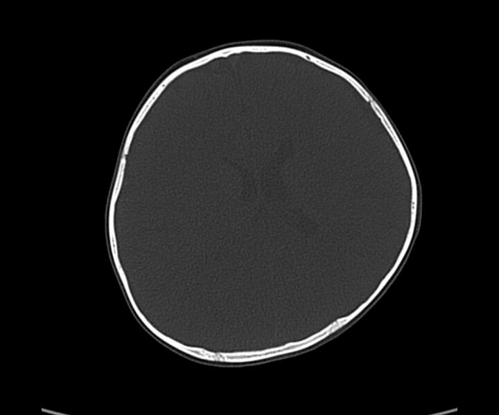 File:Acute hemorrhagic contusion (Radiopaedia 63660-72336 Axial bone window 41).jpg