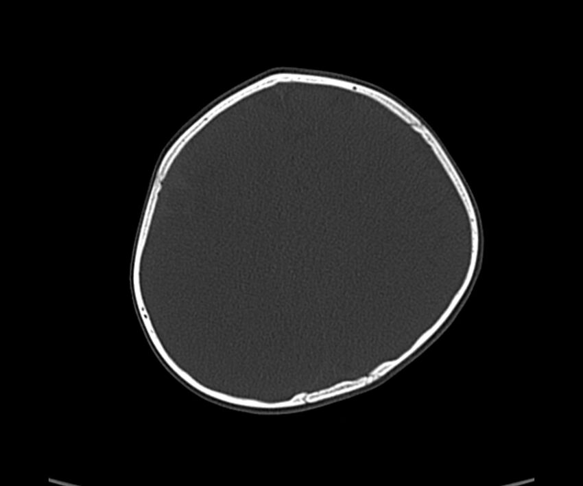Acute hemorrhagic contusion (Radiopaedia 63660-72336 Axial bone window 49).jpg